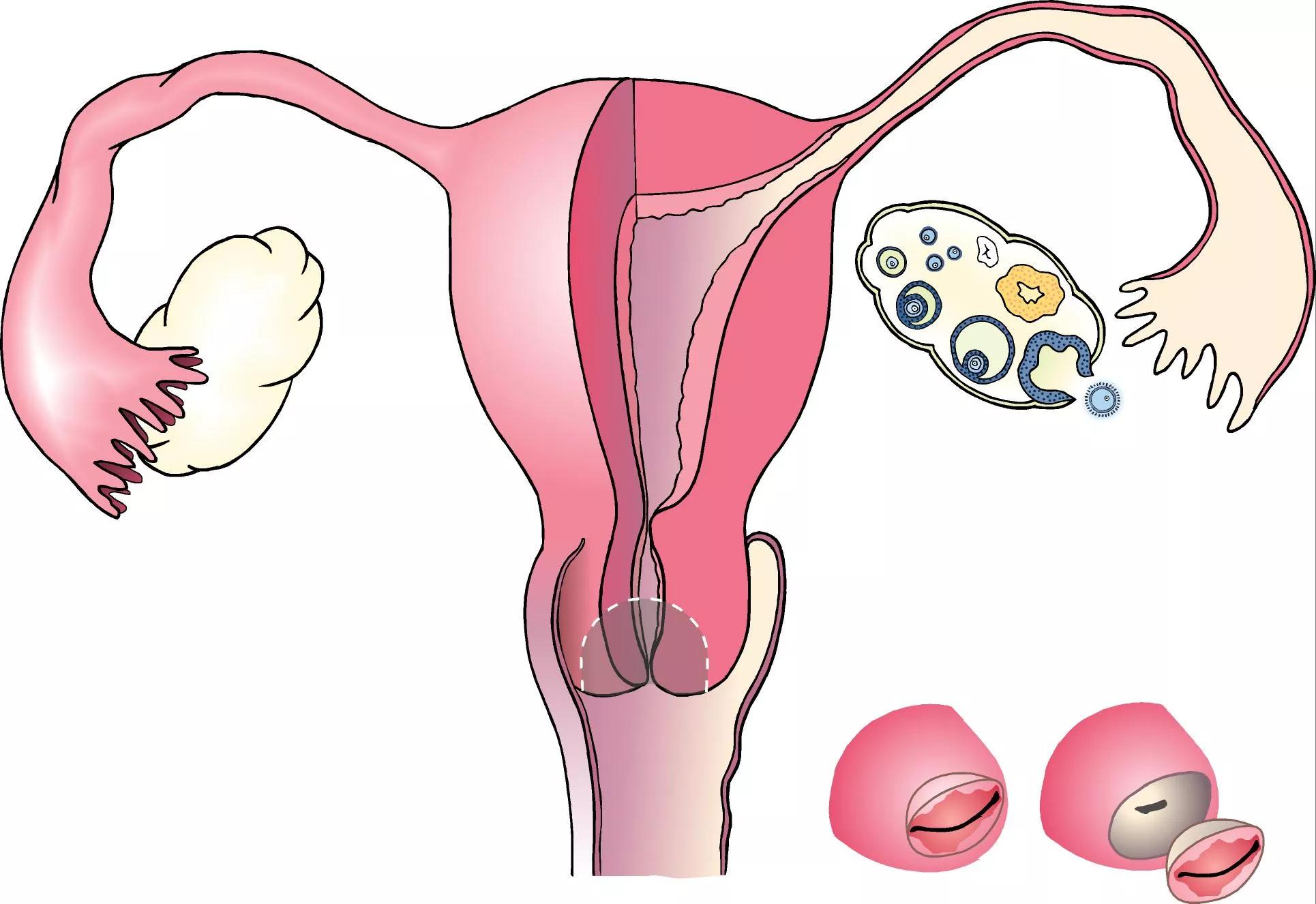Illustration af underliv set forfra med livmoder og æggeledere og æggestokke