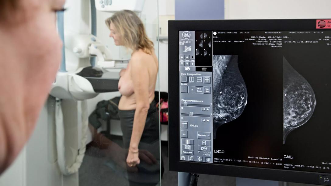 kvinde til mammografi