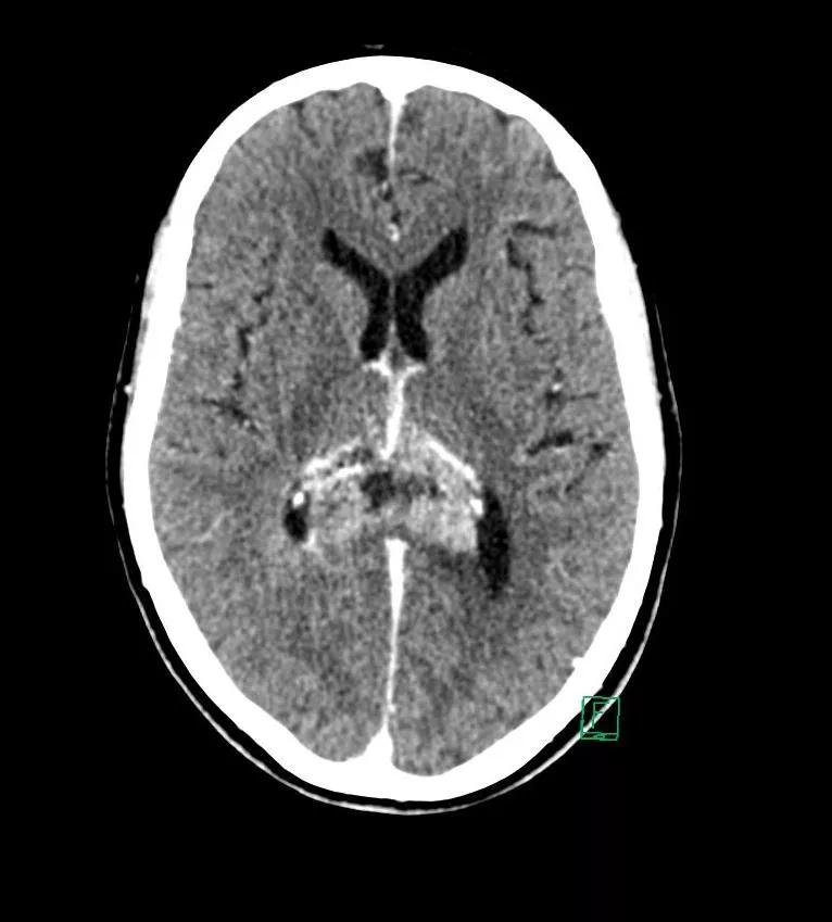 CT-scanningsbillede af hjerne med kontrastvæske